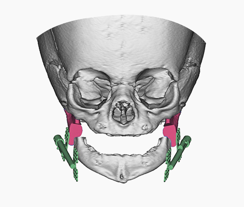 Virtual Surgery Planning (VSP)